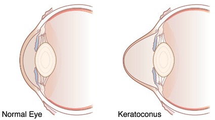keratokonus